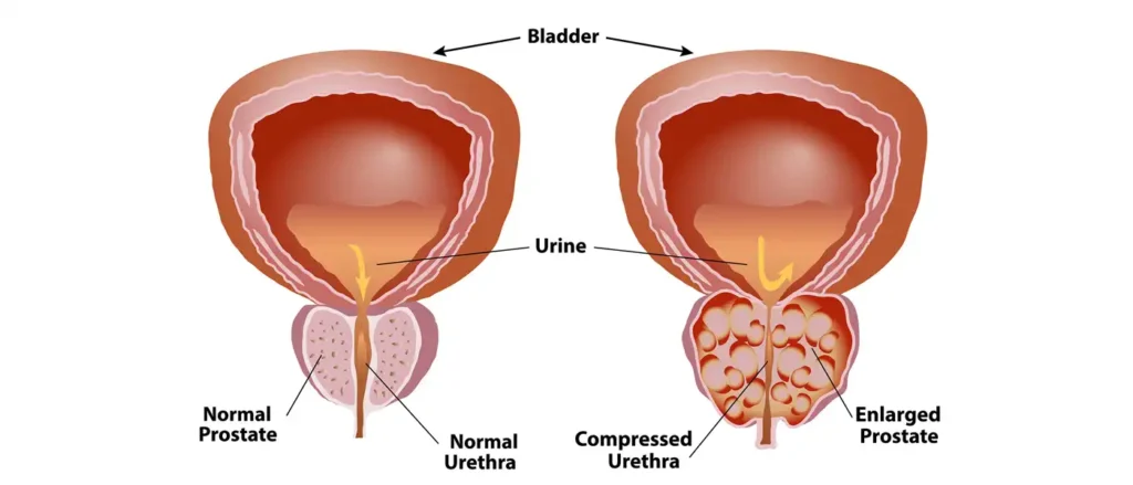 Donut analogy explaining Benign Prostatic Hyperplasia (BPH) and urinary blockage.
