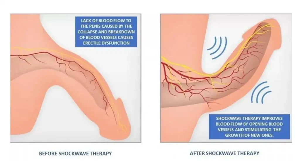 Sexual biohacks illustration showing healthy blood flow and shockwave therapy acoustic patterns for erectile dysfunction treatment
